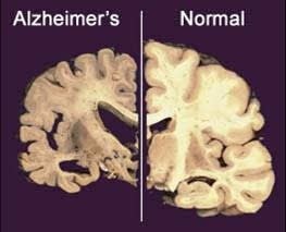  Early Alzheimer's 