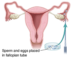 Assisted Reproductive Technology