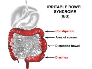 Complexity of IBS
