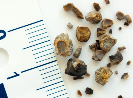 Kidney Stones – Symptoms, Causes and Treatment