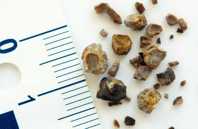 Kidney Stones – Symptoms, Causes and Treatment