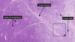 pancreatic cancer