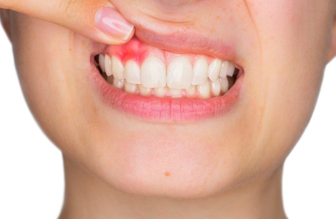 Keeping Teeth Clean: Tips to Beat Plaque and Smile Bright