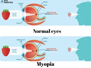 Myopia