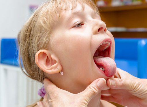 Understanding Tonsillitis in Children: Signs, Symptoms, and Treatment