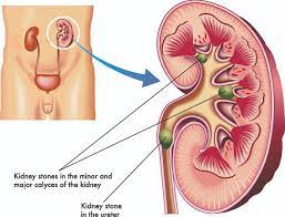 Kidney Stones