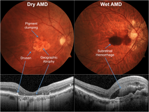 Eye Issues