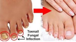 Discolored Toenails