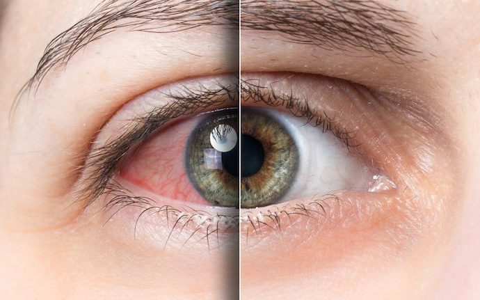 Beyond Tears: Exploring Modern Dry Eye Treatments
