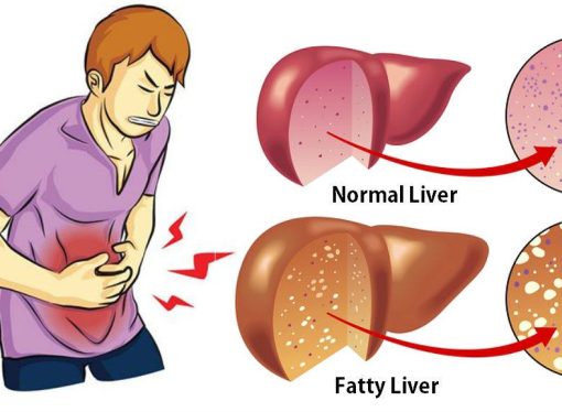 Dealing with a Fatty Liver: How to Spot, Treat, and Prevent It