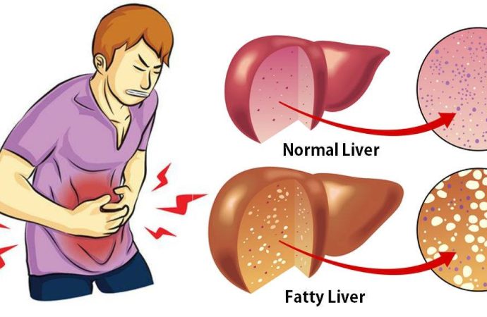 Dealing with a Fatty Liver: How to Spot, Treat, and Prevent It