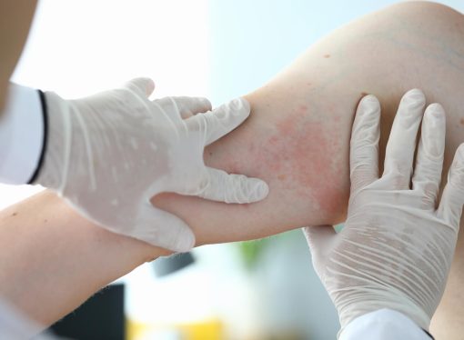 Heat Rash Alert: Identifying Signs and Effective Remedies