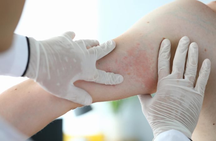 Heat Rash Alert: Identifying Signs and Effective Remedies