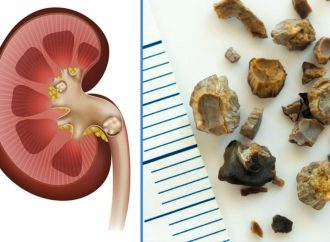 Self-Relief for Kidney Stones: Exploring Natural Possibilities