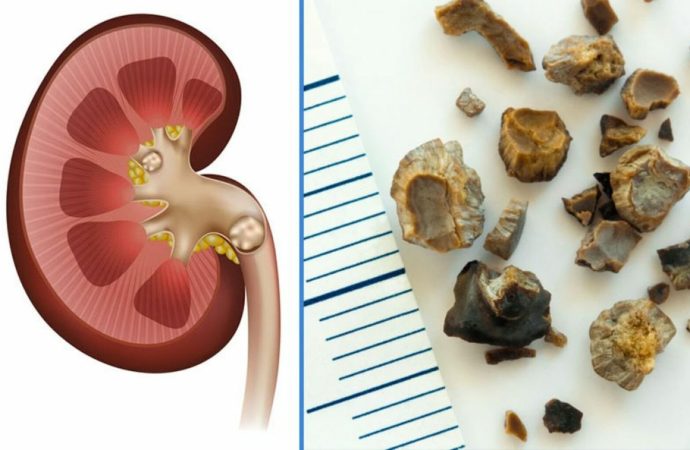 Self-Relief for Kidney Stones: Exploring Natural Possibilities