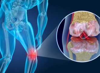 No Need to Worry: Knee Arthritis Shots Aren’t Harmful