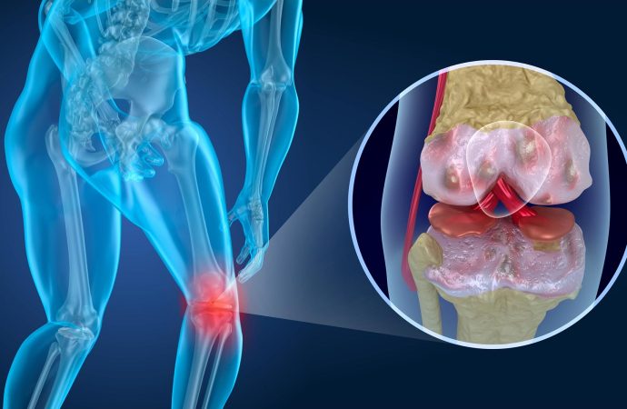 No Need to Worry: Knee Arthritis Shots Aren’t Harmful