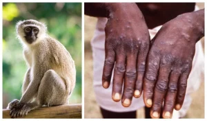 Monkeypox and Children