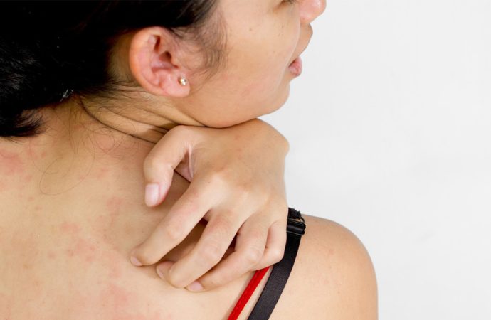 When a Rash Is More Than Just a Rash: What to Look Out For