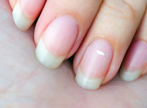 White Marks on Nails: What Mean and How to Deal with Them