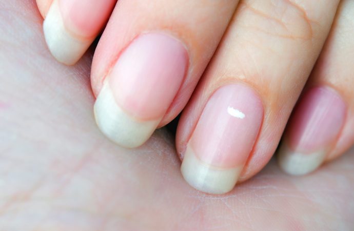 White Marks on Nails: What Mean and How to Deal with Them