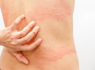 What Causes Shingles? Exploring the Triggers Behind the Rash