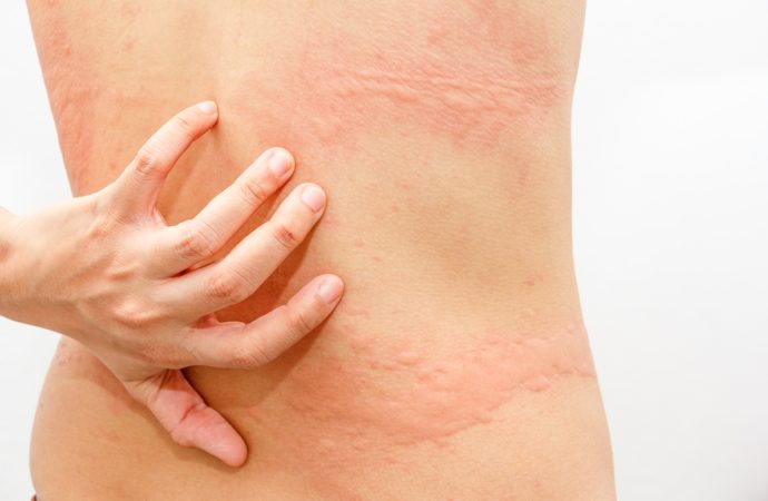 What Causes Shingles? Exploring the Triggers Behind the Rash