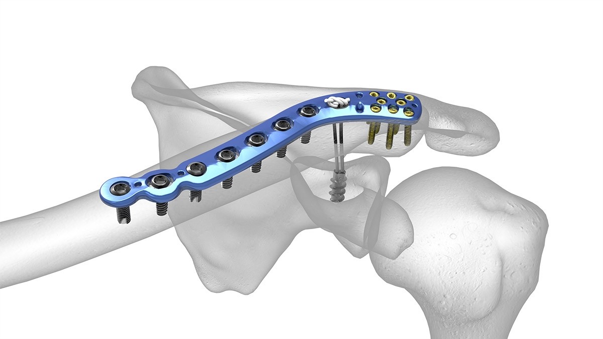 Biodegradable Medical Devices: The Future of Healthcare