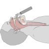 Single Use Intubation Stylet: Benefits for Clinicians