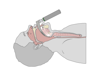 Single Use Intubation Stylet: Benefits for Clinicians