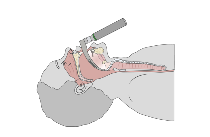 Single Use Intubation Stylet: Benefits for Clinicians