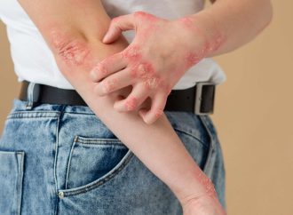 Filariasis in the USA: Causes, Treatment, and Prevention