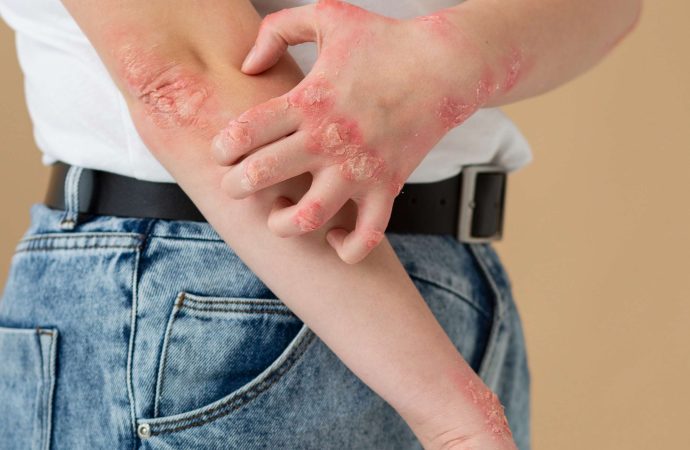 Filariasis in the USA: Causes, Treatment, and Prevention