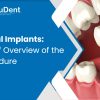 Dental Implants: A Brief Overview of the Procedure