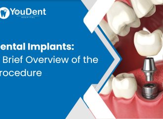 Dental Implants: A Brief Overview of the Procedure
