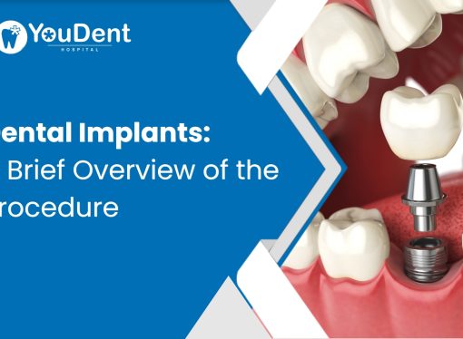 Dental Implants: A Brief Overview of the Procedure