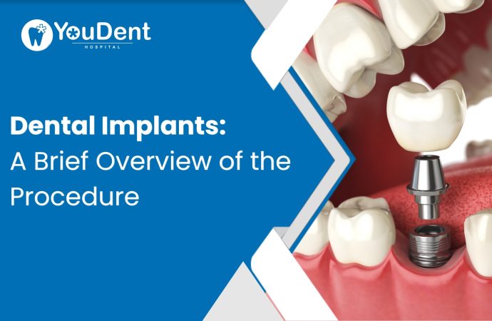 Dental Implants: A Brief Overview of the Procedure