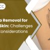 Tattoo Removal for Dark Skin: Challenges and Considerations