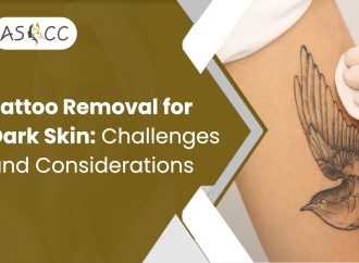 Tattoo Removal for Dark Skin: Challenges and Considerations