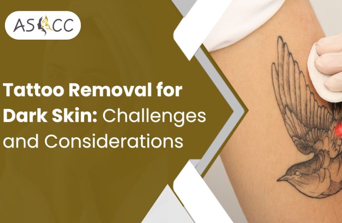 Tattoo Removal for Dark Skin: Challenges and Considerations
