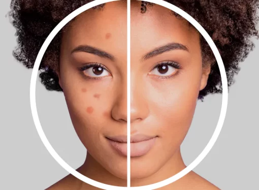 EXION Treatment in Clermont, FL | Skin Renewal with No Downtime