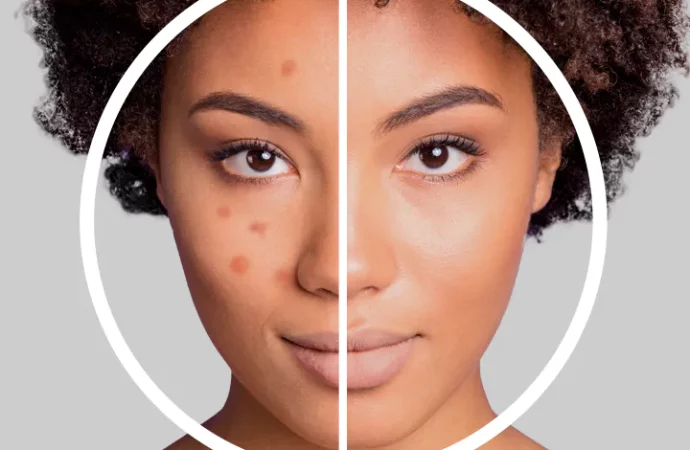 EXION Treatment in Clermont, FL | Skin Renewal with No Downtime