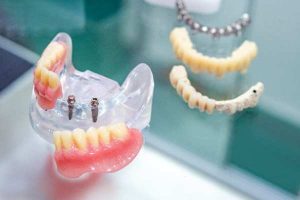 Implants