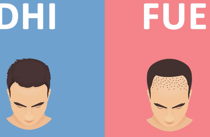 FUE vs FUT: Which Hair Transplant Clinic Offers the Best Method?