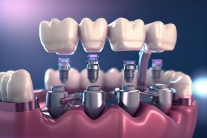 Dental Implants Market