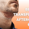 Beard Implant Care Tips for Long-Lasting Results
