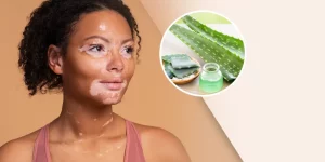 Herbal Supplements Help Repigment Vitiligo Patches