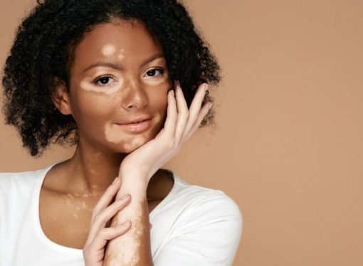 Breakthroughs in UV Light Therapy That Are Changing Vitiligo Treatment