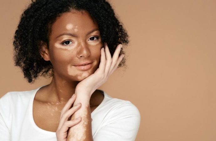 Breakthroughs in UV Light Therapy That Are Changing Vitiligo Treatment