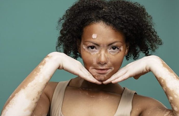 Herbal Supplements That May Help Repigment Vitiligo Patches